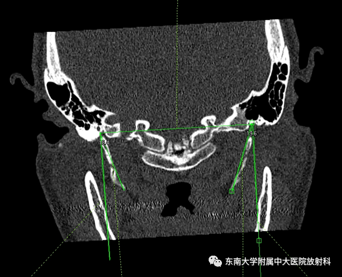 影像PPT - 【PPT】茎突综合征-4