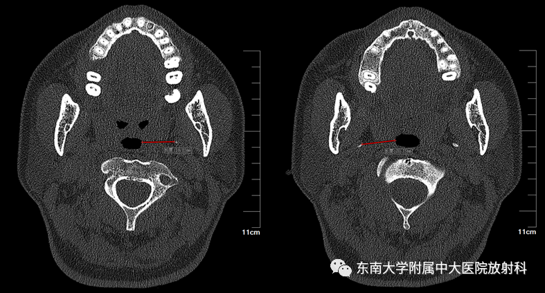 影像PPT - 【PPT】茎突综合征-1