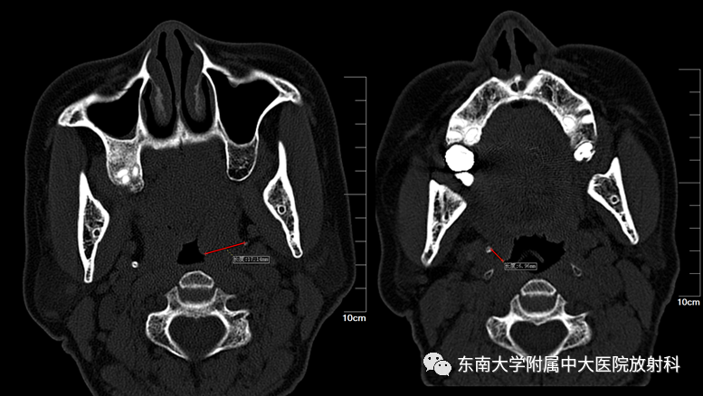 影像PPT - 【PPT】茎突综合征-6
