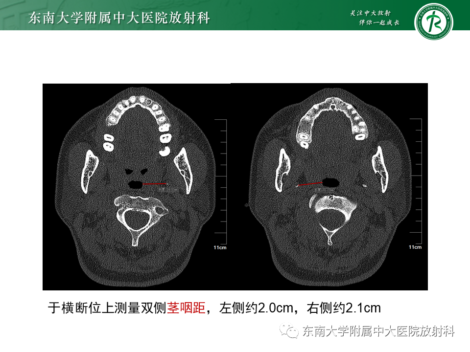 影像PPT - 【PPT】茎突综合征-10