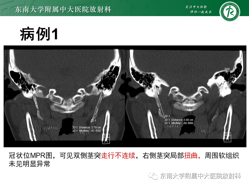 影像PPT - 【PPT】茎突综合征-9