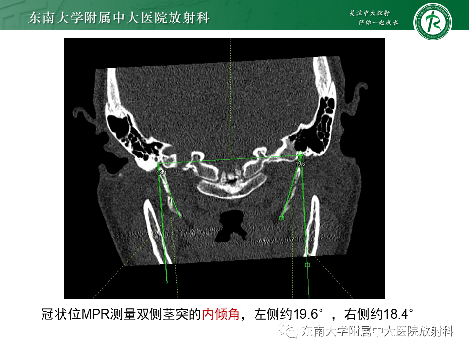 影像PPT - 【PPT】茎突综合征-12