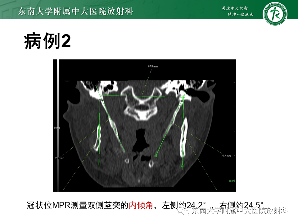影像PPT - 【PPT】茎突综合征-13