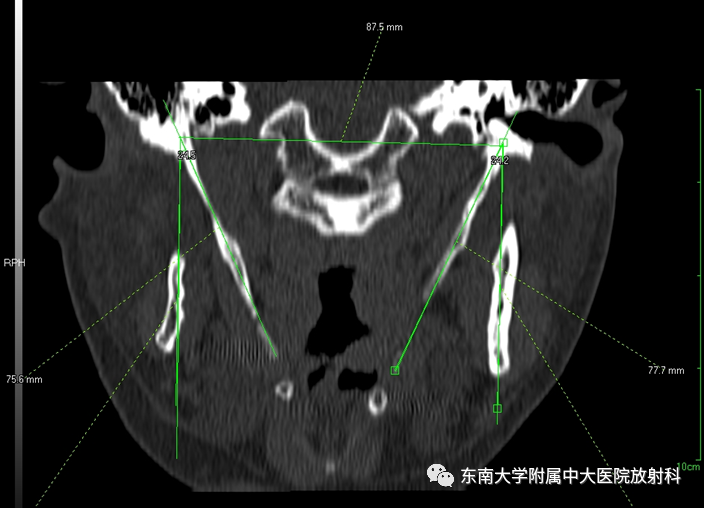 影像PPT - 【PPT】茎突综合征-8
