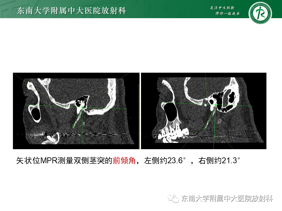 影像PPT - 【PPT】茎突综合征-11