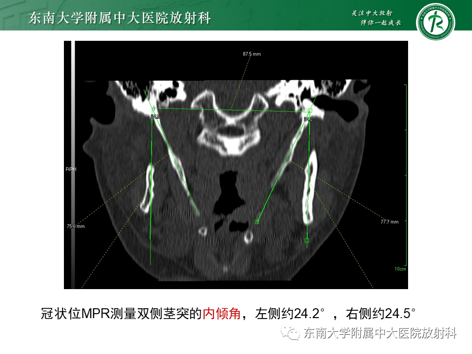 影像PPT - 【PPT】茎突综合征-15