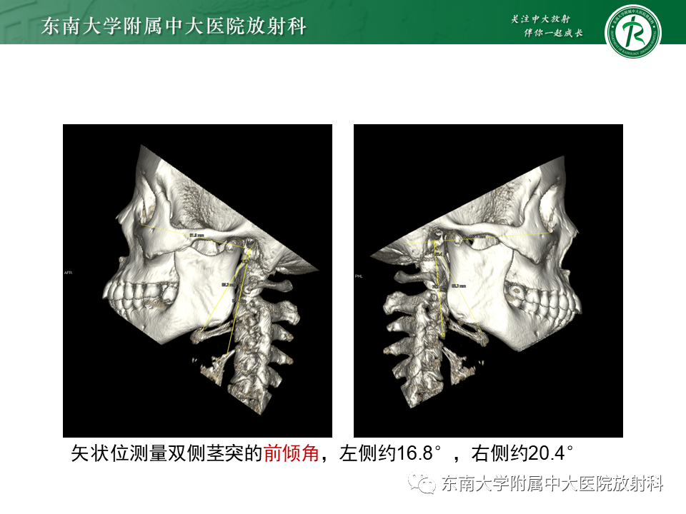 影像PPT - 【PPT】茎突综合征-14