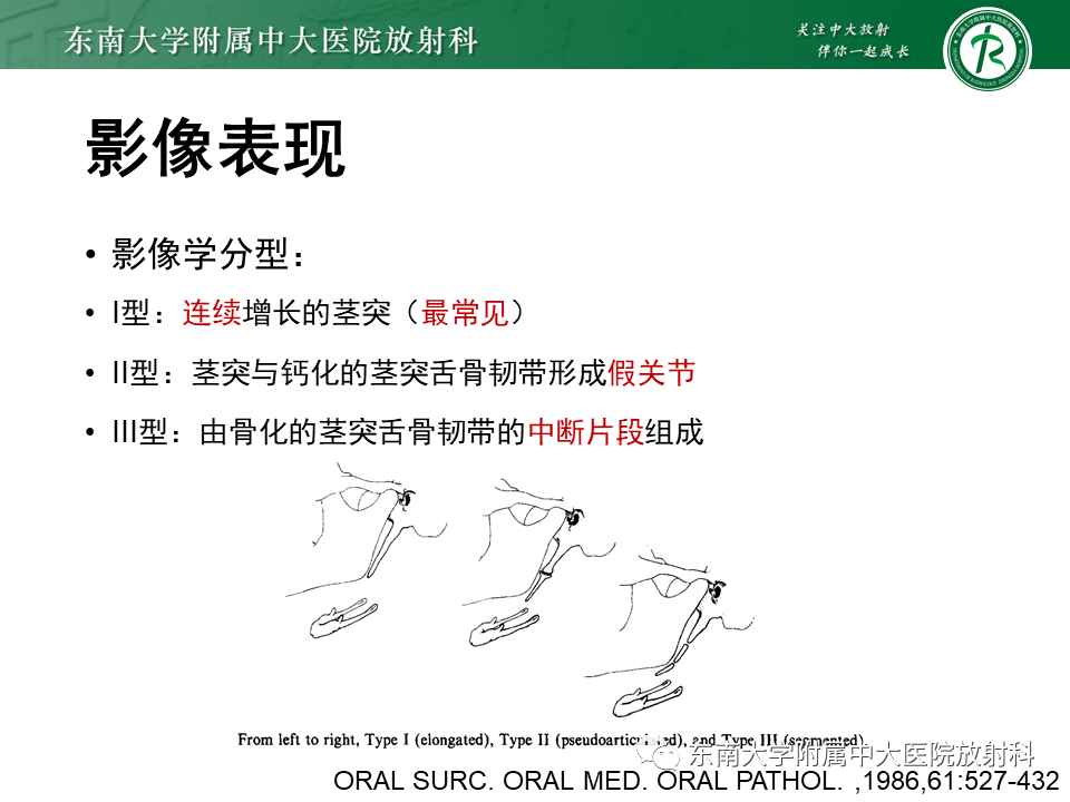 影像PPT - 【PPT】茎突综合征-30