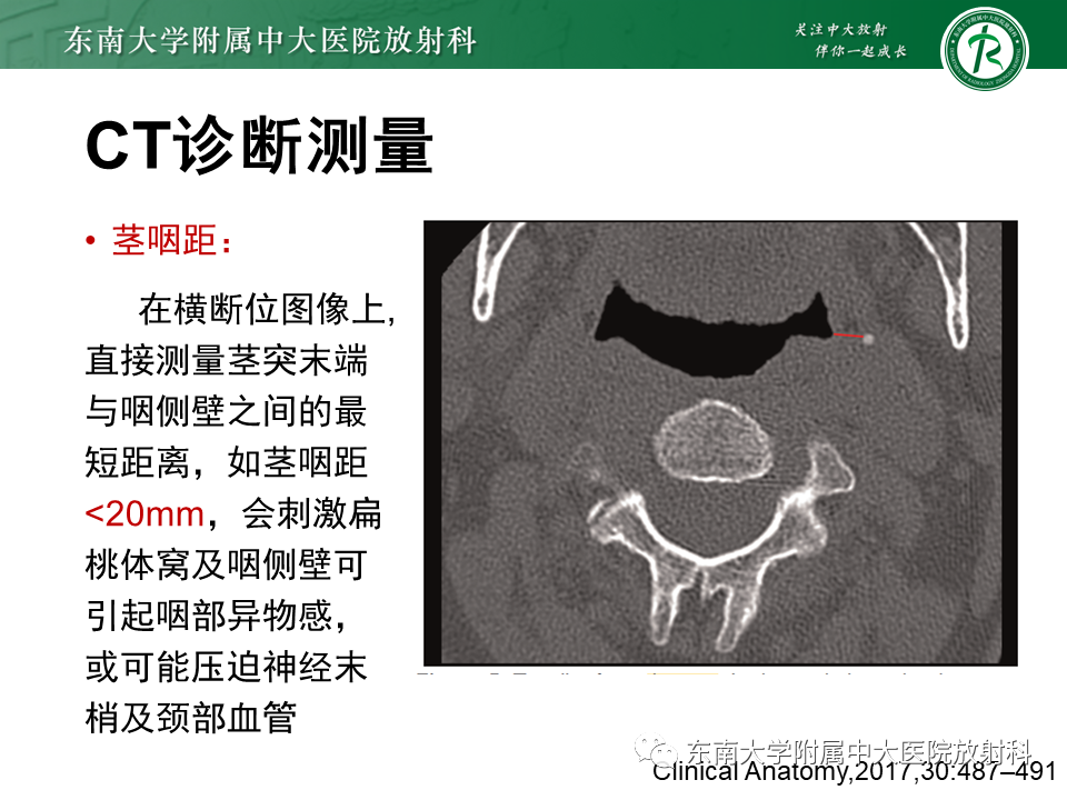影像PPT - 【PPT】茎突综合征-34