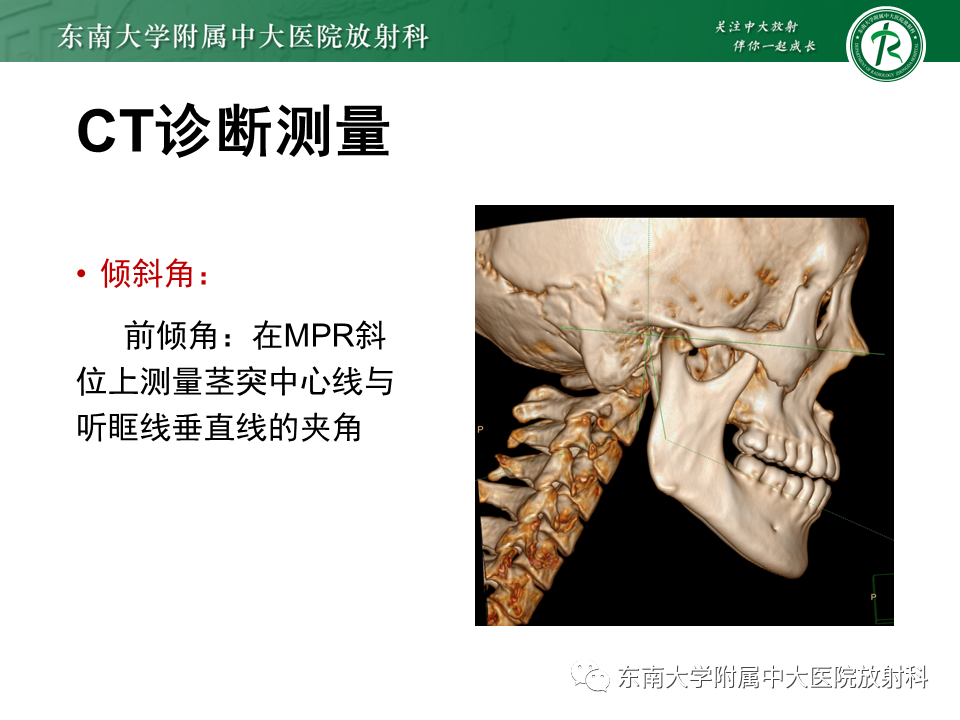 影像PPT - 【PPT】茎突综合征-35
