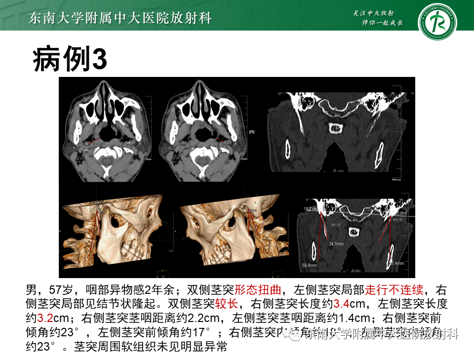 影像PPT - 【PPT】茎突综合征-37