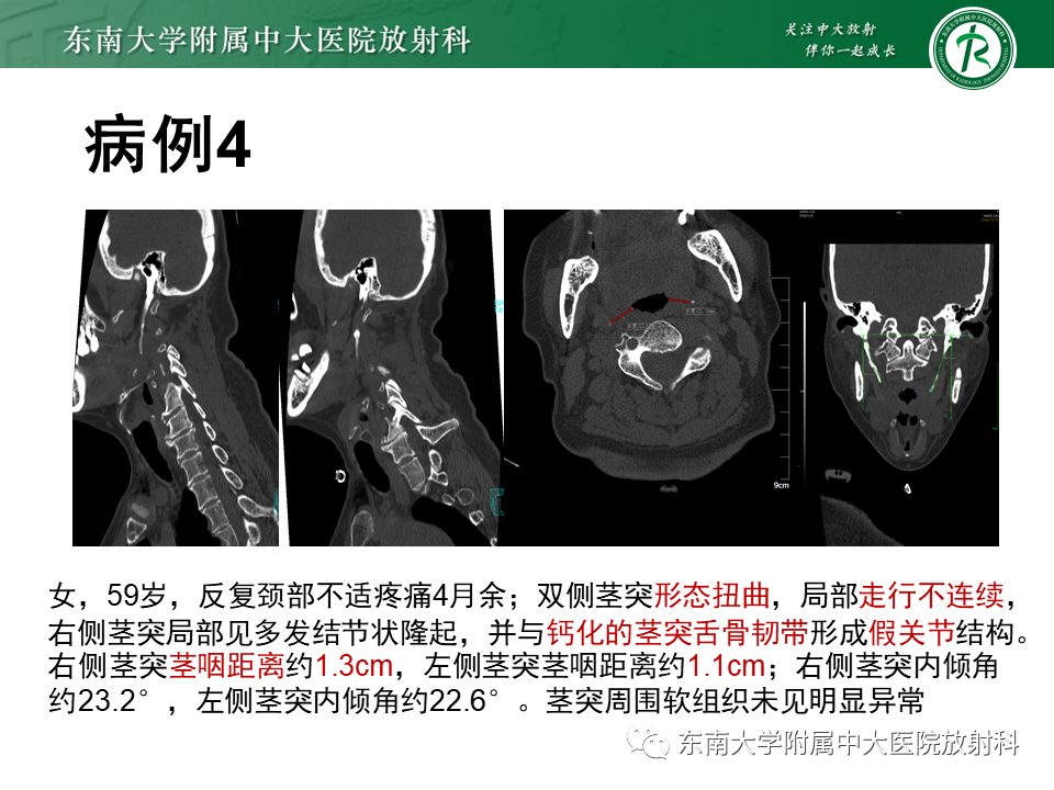 影像PPT - 【PPT】茎突综合征-39