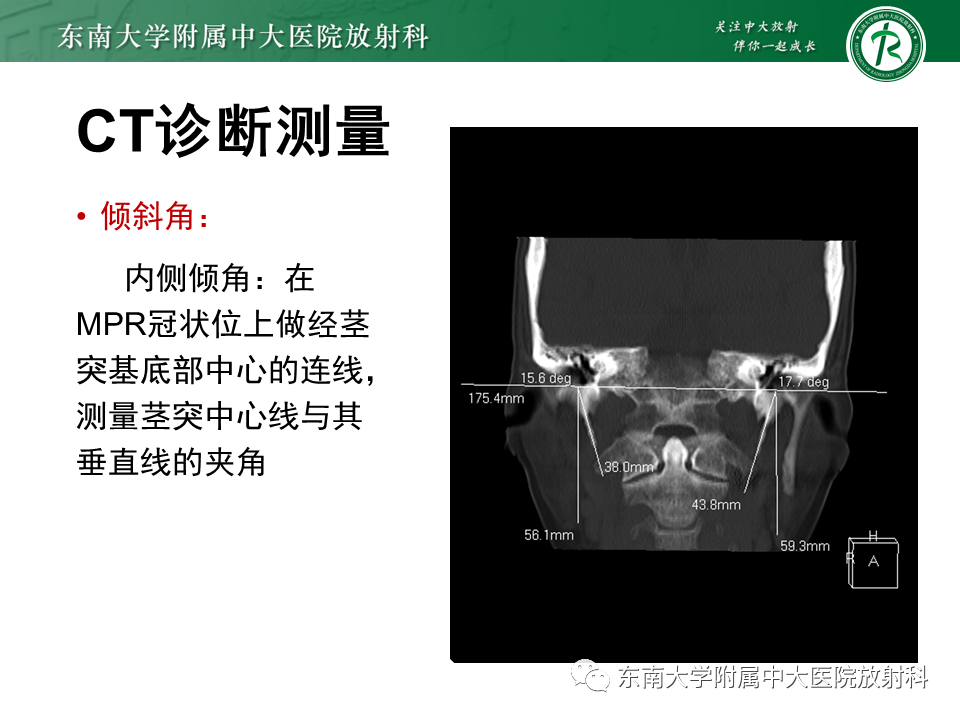 影像PPT - 【PPT】茎突综合征-36