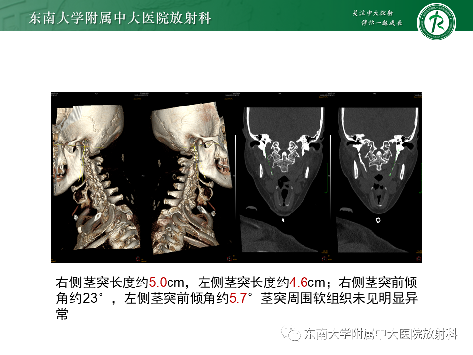 影像PPT - 【PPT】茎突综合征-40