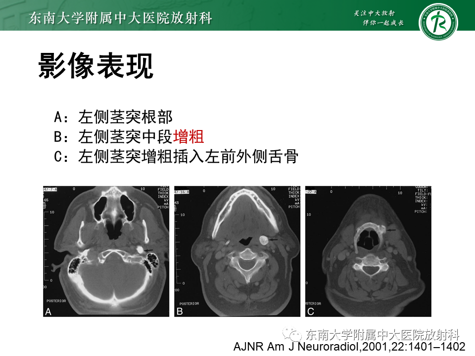 影像PPT - 【PPT】茎突综合征-41