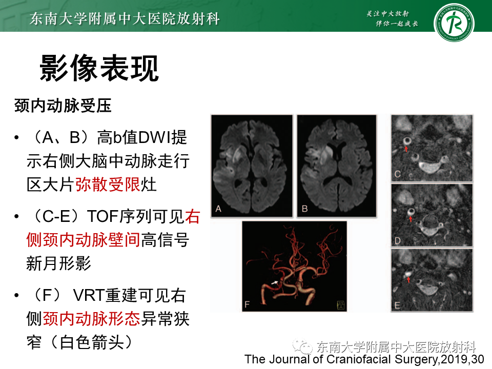 影像PPT - 【PPT】茎突综合征-42