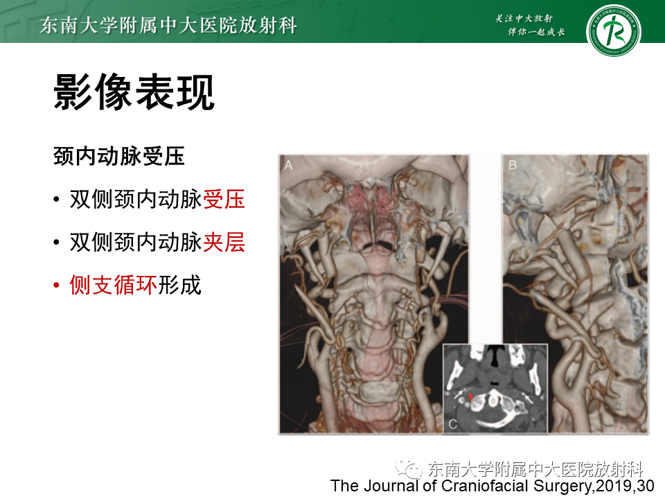 影像PPT - 【PPT】茎突综合征-43