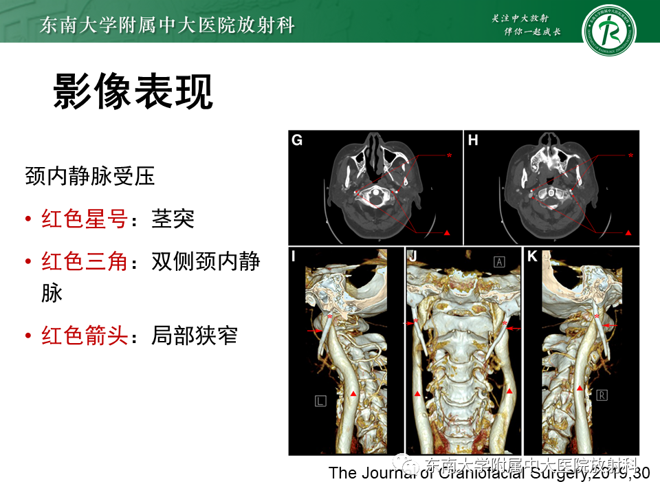 影像PPT - 【PPT】茎突综合征-44