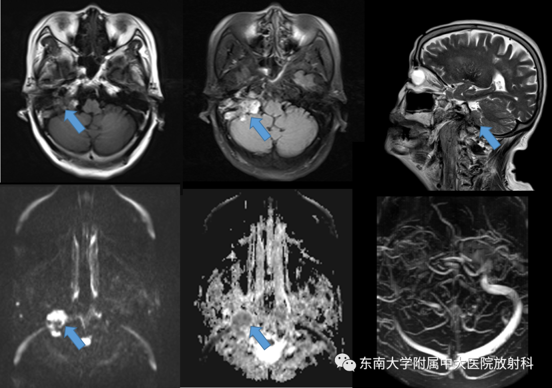 影像PPT - 【PPT】颈静脉球瘤-1 影像PPT - 【PPT】颈静脉球瘤-1