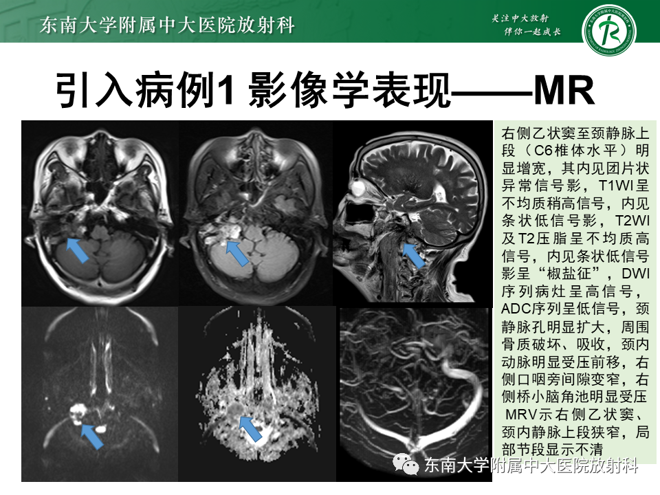 影像PPT - 【PPT】颈静脉球瘤-3 影像PPT - 【PPT】颈静脉球瘤-3