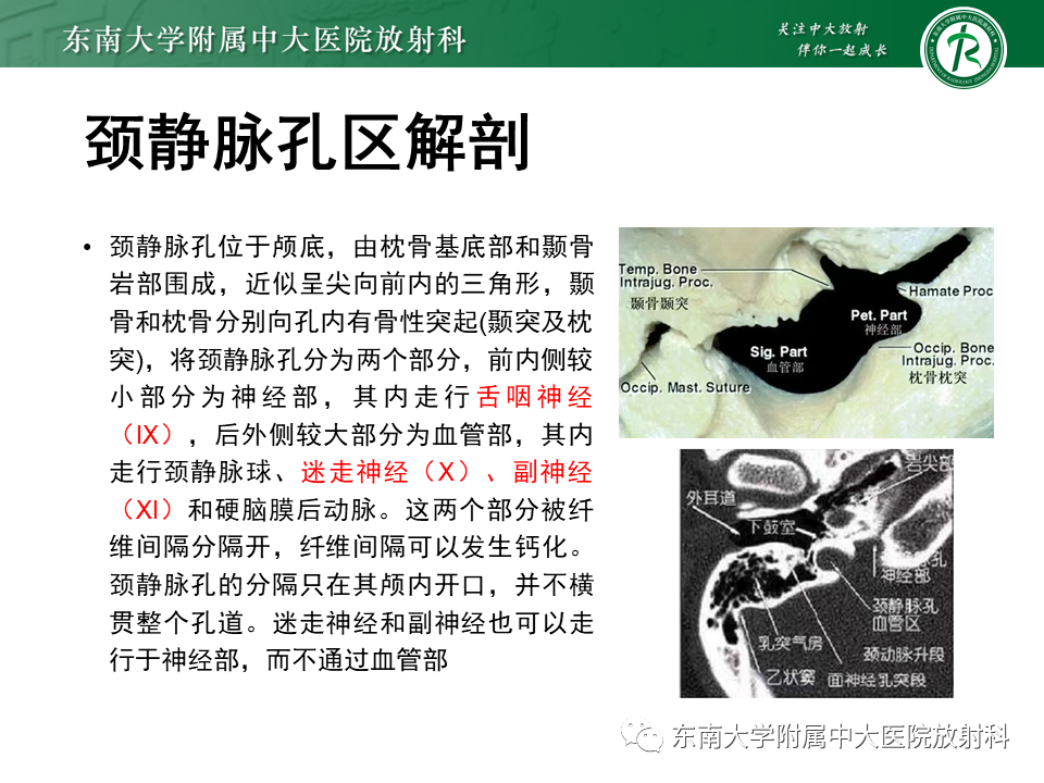 影像PPT - 【PPT】颈静脉球瘤-6 影像PPT - 【PPT】颈静脉球瘤-6