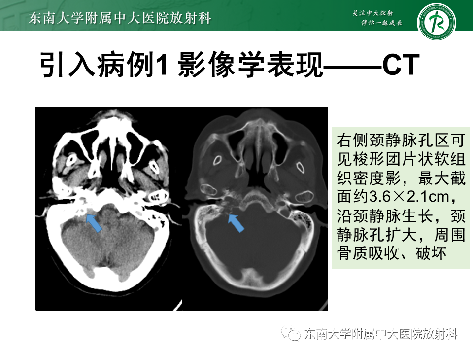 影像PPT - 【PPT】颈静脉球瘤-4 影像PPT - 【PPT】颈静脉球瘤-4