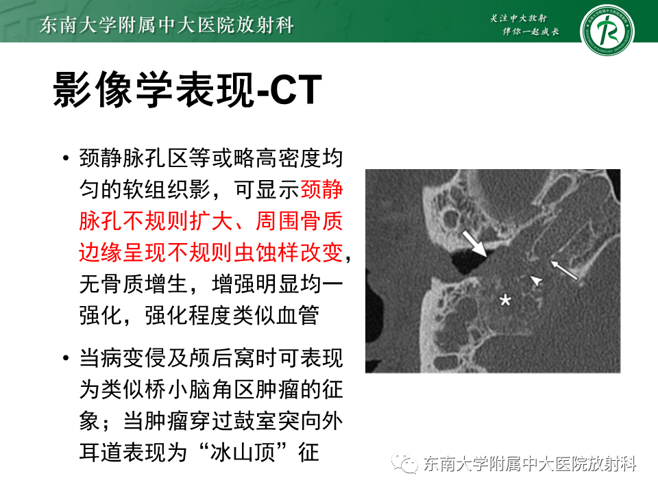 影像PPT - 【PPT】颈静脉球瘤-12 影像PPT - 【PPT】颈静脉球瘤-12