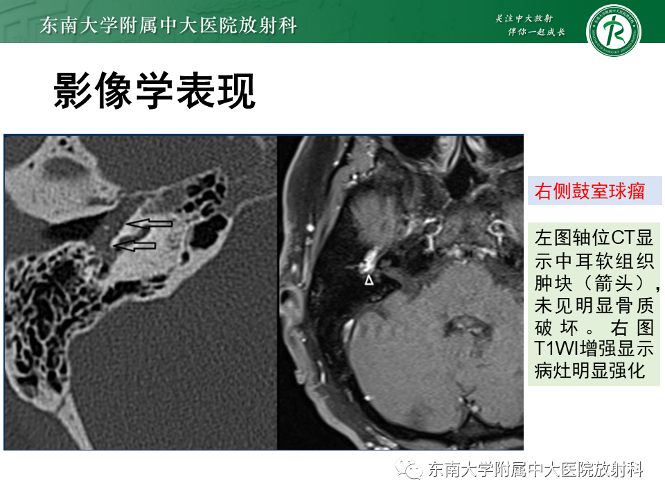 影像PPT - 【PPT】颈静脉球瘤-15 影像PPT - 【PPT】颈静脉球瘤-15