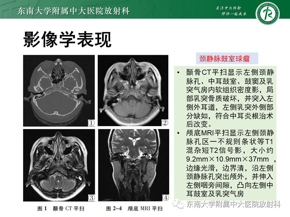 影像PPT - 【PPT】颈静脉球瘤-17 影像PPT - 【PPT】颈静脉球瘤-17