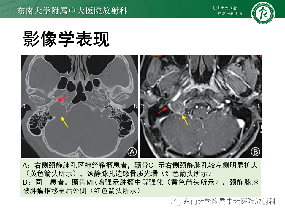 影像PPT - 【PPT】颈静脉球瘤-21 影像PPT - 【PPT】颈静脉球瘤-21