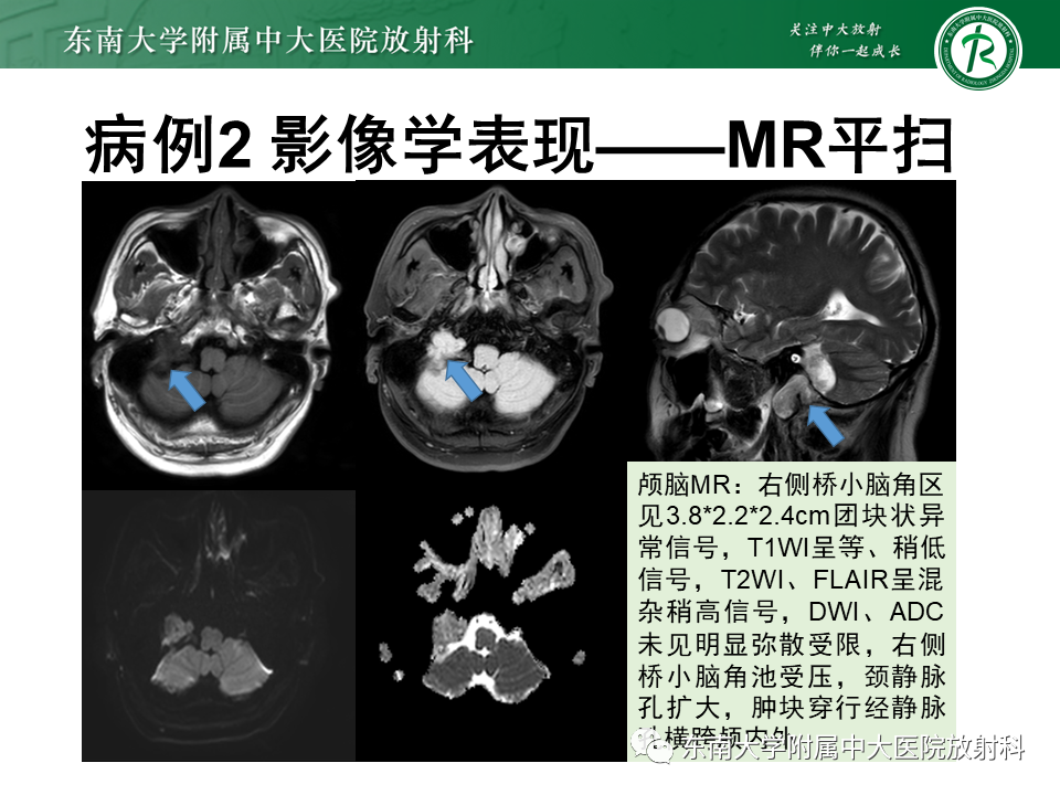 影像PPT - 【PPT】颈静脉球瘤-23 影像PPT - 【PPT】颈静脉球瘤-23