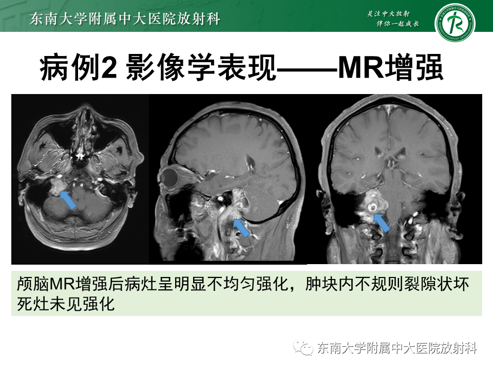 影像PPT - 【PPT】颈静脉球瘤-24 影像PPT - 【PPT】颈静脉球瘤-24