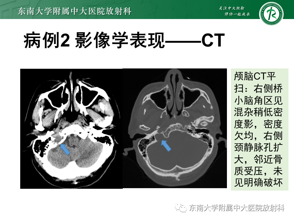 影像PPT - 【PPT】颈静脉球瘤-25 影像PPT - 【PPT】颈静脉球瘤-25