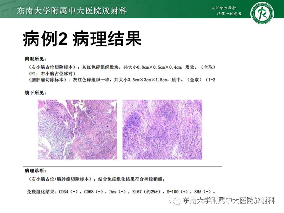 影像PPT - 【PPT】颈静脉球瘤-26 影像PPT - 【PPT】颈静脉球瘤-26