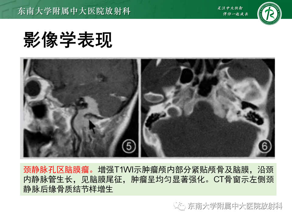 影像PPT - 【PPT】颈静脉球瘤-29 影像PPT - 【PPT】颈静脉球瘤-29