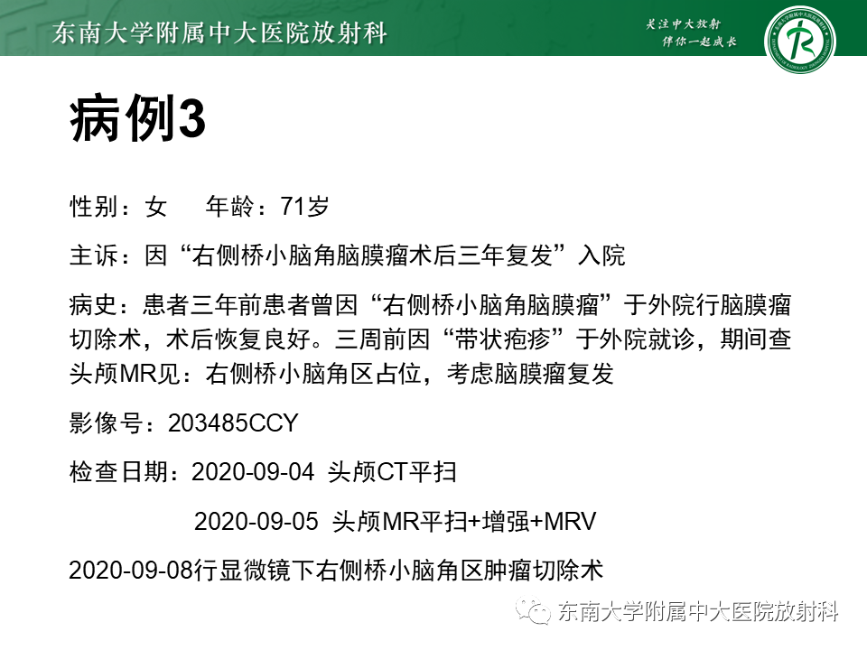 影像PPT - 【PPT】颈静脉球瘤-31 影像PPT - 【PPT】颈静脉球瘤-31