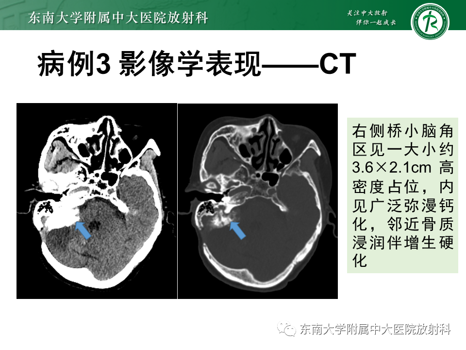 影像PPT - 【PPT】颈静脉球瘤-32 影像PPT - 【PPT】颈静脉球瘤-32