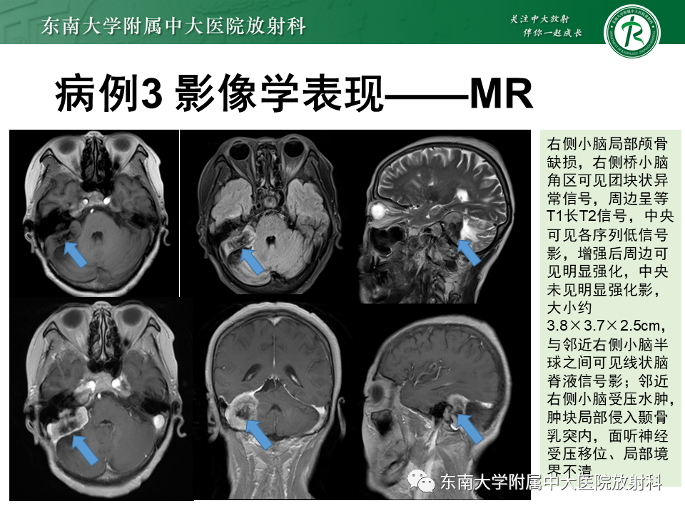 影像PPT - 【PPT】颈静脉球瘤-33 影像PPT - 【PPT】颈静脉球瘤-33