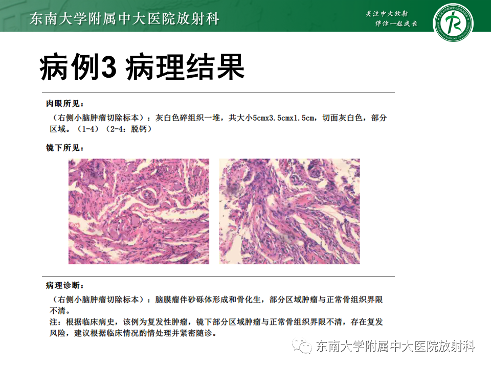 影像PPT - 【PPT】颈静脉球瘤-34 影像PPT - 【PPT】颈静脉球瘤-34