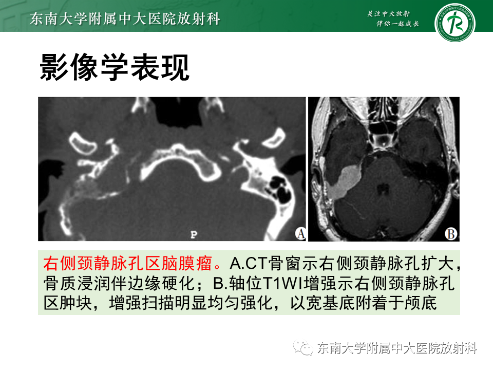 影像PPT - 【PPT】颈静脉球瘤-30 影像PPT - 【PPT】颈静脉球瘤-30