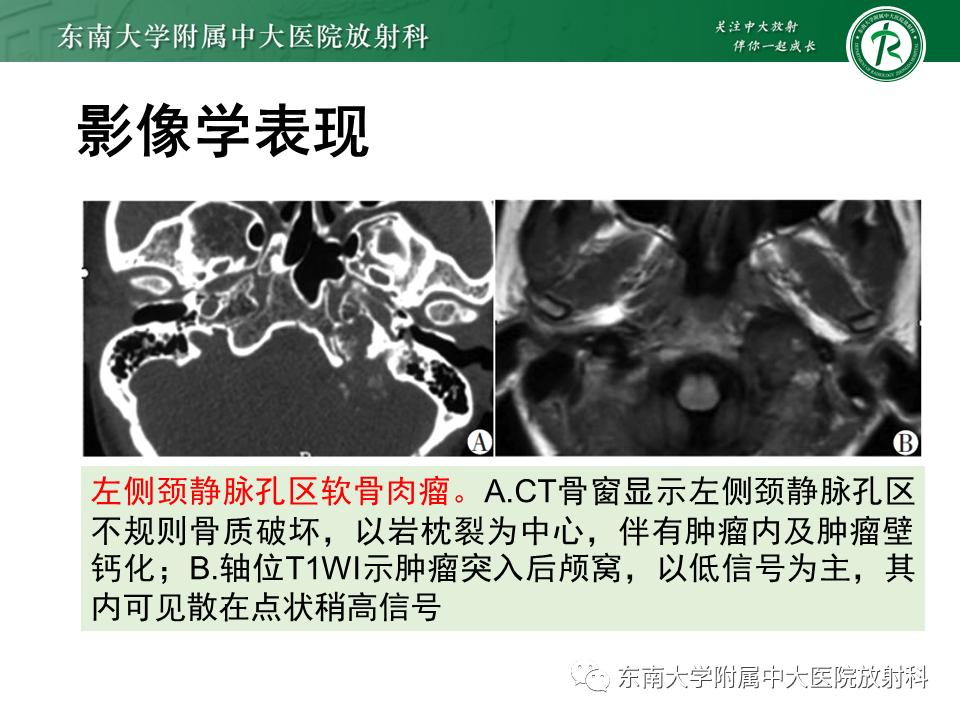 影像PPT - 【PPT】颈静脉球瘤-36 影像PPT - 【PPT】颈静脉球瘤-36