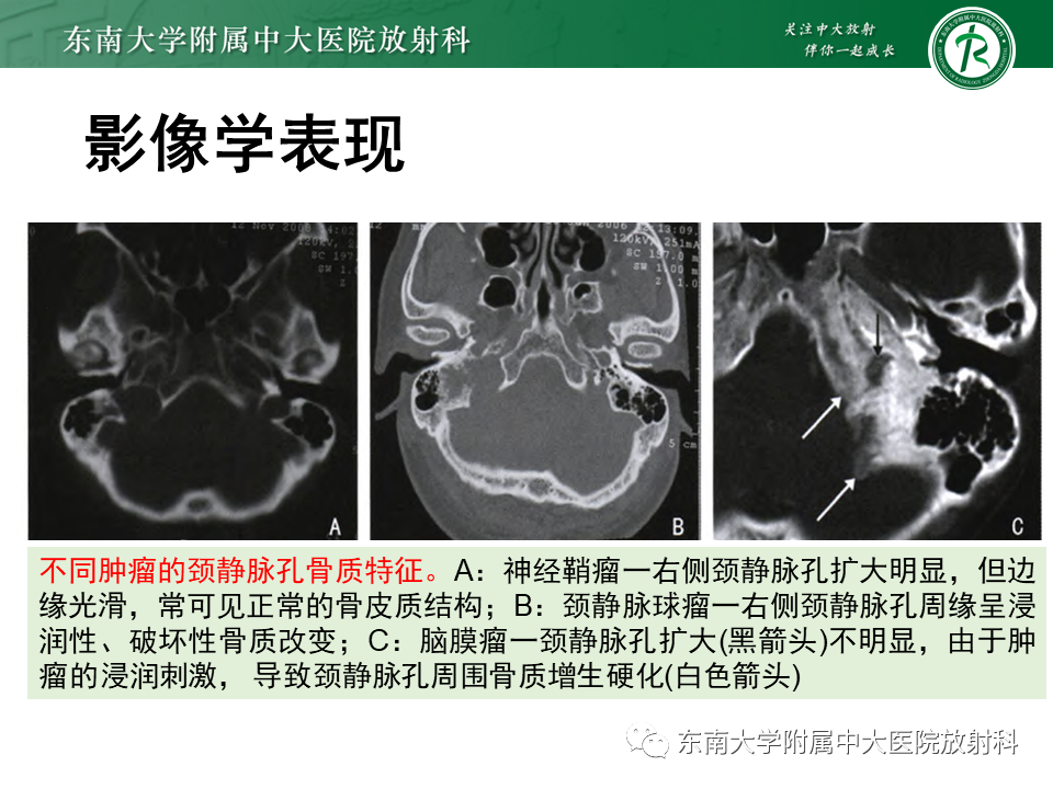 影像PPT - 【PPT】颈静脉球瘤-38 影像PPT - 【PPT】颈静脉球瘤-38