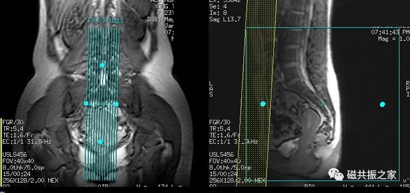 影像PPT - 磁共振(MRI)骶尾椎扫描技术-2 影像PPT - 磁共振(MRI)骶尾椎扫描技术-2