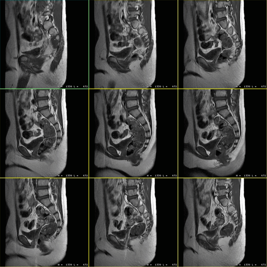 影像PPT - 磁共振(MRI)骶尾椎扫描技术-5 影像PPT - 磁共振(MRI)骶尾椎扫描技术-5