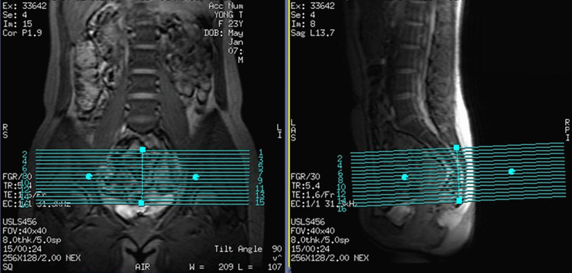 影像PPT - 磁共振(MRI)骶尾椎扫描技术-3 影像PPT - 磁共振(MRI)骶尾椎扫描技术-3