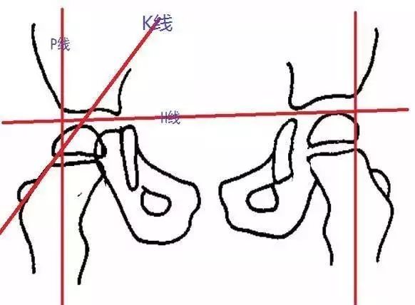 影像PPT - 骨盆X线解剖详解-4