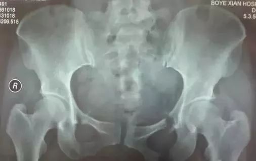 影像PPT - 骨盆X线解剖详解-11