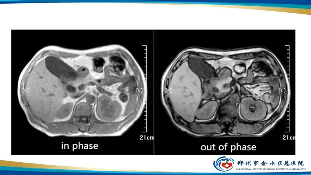 影像PPT - 【PPT】磁共振化学位移成像—水脂分离技术原理及应用浅述-22