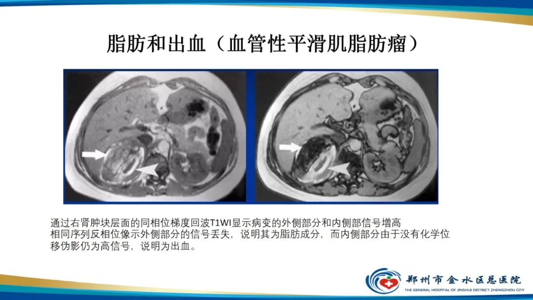 影像PPT - 【PPT】磁共振化学位移成像—水脂分离技术原理及应用浅述-26