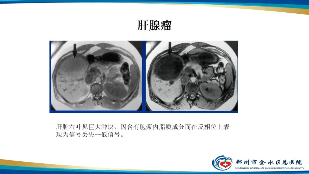 影像PPT - 【PPT】磁共振化学位移成像—水脂分离技术原理及应用浅述-29